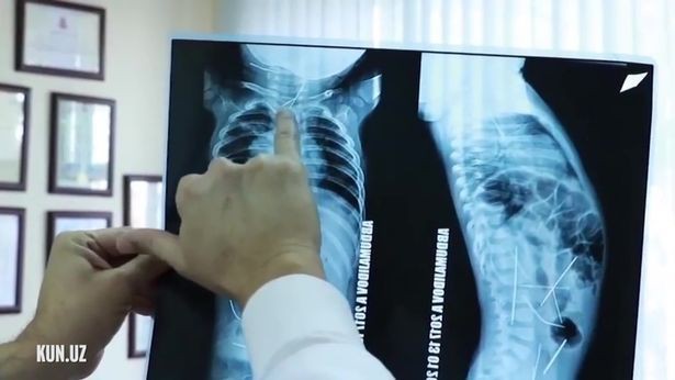 Uzbekistan: Con sốt cao, tiểu tiện khó khăn, mẹ đưa đến bệnh viện và ngã quỵ khi nhìn thấy hình chụp X-quang - Ảnh 1.
