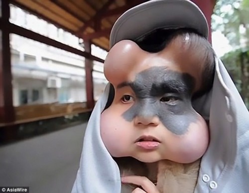 Căn bệnh lạ khiến cô gái 9X có 4 trái bóng trên khuôn mặt - Ảnh 2.