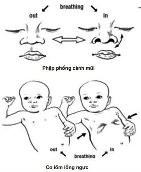 Cách điều trị các bệnh hô hấp khi chuyển mùa ở trẻ - Ảnh 1.