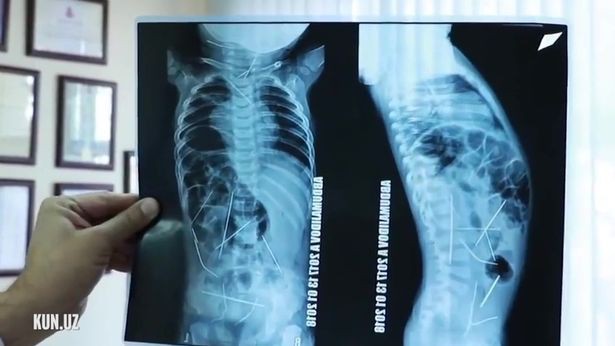 Uzbekistan: Con sốt cao, tiểu tiện khó khăn, mẹ đưa đến bệnh viện và ngã quỵ khi nhìn thấy hình chụp X-quang - Ảnh 3.