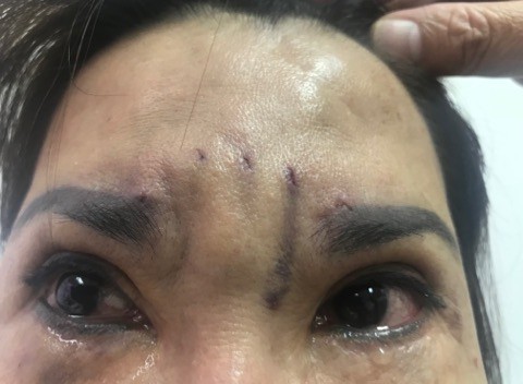 Treo chỉ làm đẹp, bị biến dạng luôn đôi mắt - Ảnh 1. Treo chỉ làm đẹp, bị biến dạng luôn đôi mắt - Ảnh 1.