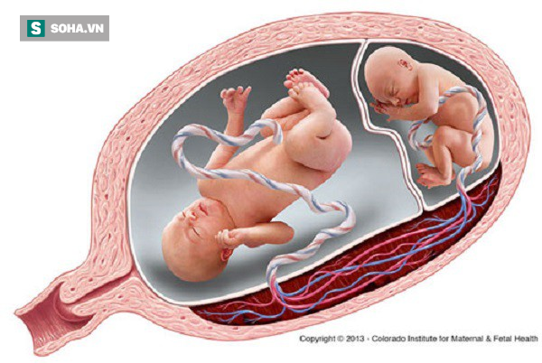 Kỳ lạ cặp sinh đôi có 2 dây rốn xoắn tít như tết tóc - Ảnh 1.