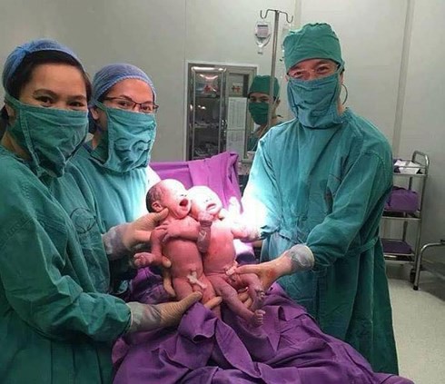 2 bé trai sinh đôi đầu tiên nhờ thụ tinh ống nghiệm IVF tại Quảng Ninh - Ảnh 1.