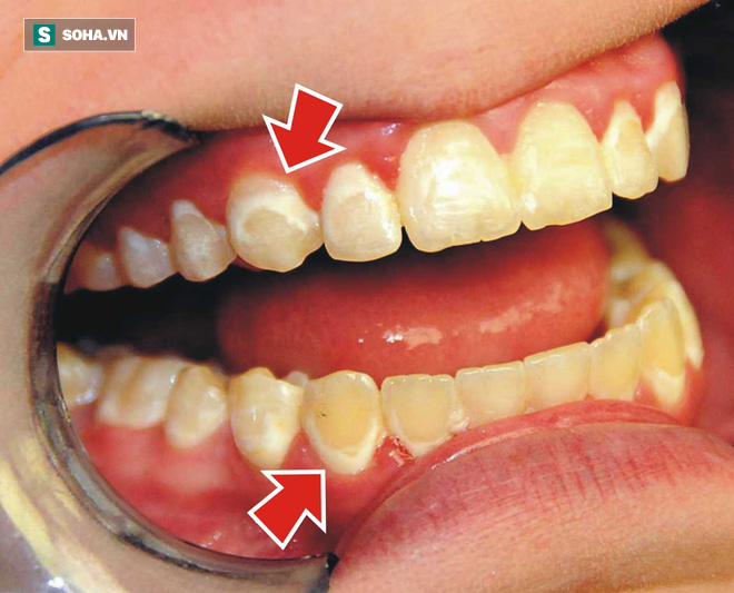 90% người Việt sâu răng, viêm lợi, mất răng... do thói quen sai lầm này: Bạn có mắc phải? - Ảnh 1.
