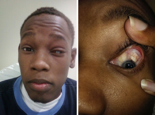 Chàng trai 25 tuổi bị mù một bên mắt vì đeo kính áp tròng giá rẻ - Ảnh 2.