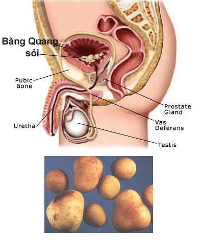 Bệnh tuyến tiền liệt – chớ coi thường! - Ảnh 1.