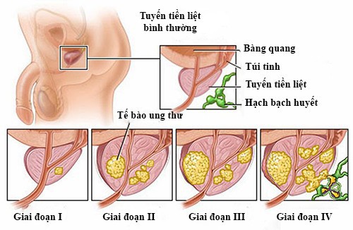 Tại sao nam giới cần tầm soát tuyến tiền liệt? - Ảnh 1.