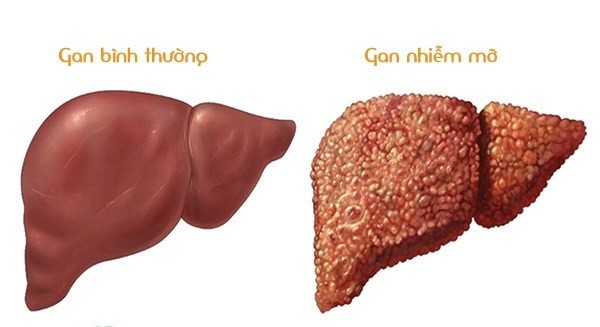 3 thủ phạm chính dẫn đến gan nhiễm mỡ bạn không thể coi thường - Ảnh 1.