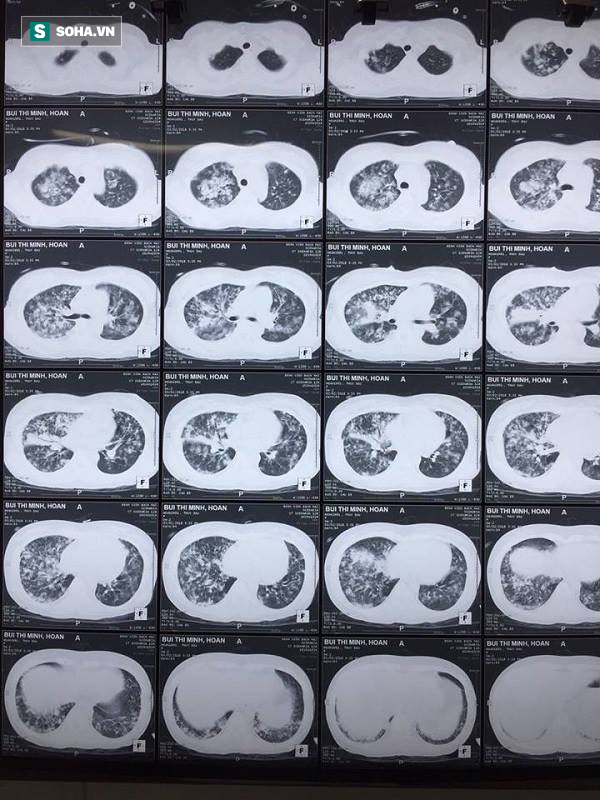 Miền Bắc đang bước vào đợt cao điểm của dịch thuỷ đậu: Đã có nhiều ca biến chứng nặng - Ảnh 1. Miền Bắc đang bước vào đợt cao điểm của dịch thuỷ đậu: Đã có nhiều ca biến chứng nặng - Ảnh 1.