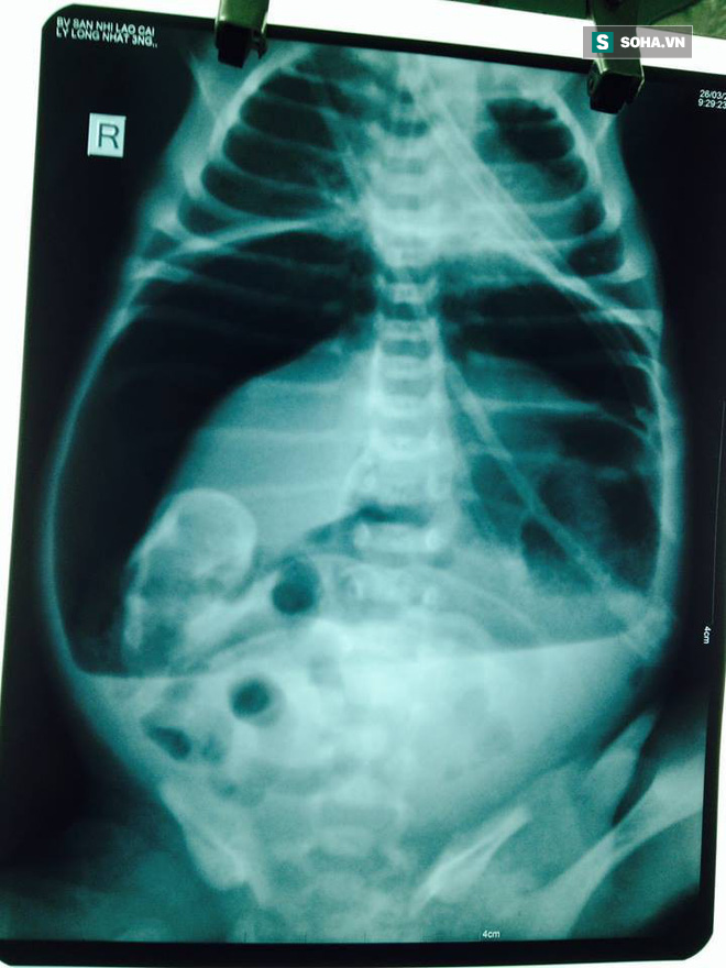 Hiếm gặp: Cháu bé sơ sinh 2 ngày tuổi ở Lào Cai bị vỡ dạ dày  - Ảnh 1.