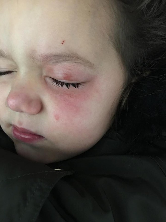 Người mẹ lên tiếng cảnh báo sau khi viên nước giặt phát nổ khiến con gái 4 tuổi bị bỏng và chấn thương vùng mắt - Ảnh 2.