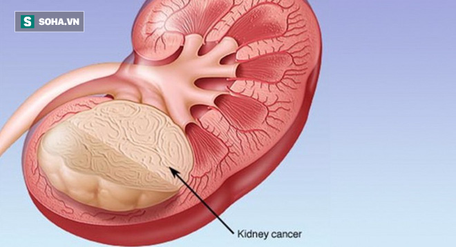 3 dấu hiệu điển hình bệnh ung thư thận: Nếu không can thiệp thì không sống được quá 1 năm - Ảnh 2.