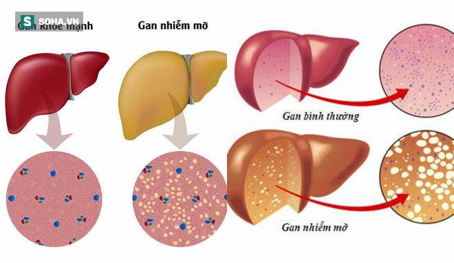 Nguy cơ mắc 1 bệnh đe dọa mạng sống cao gấp đôi nếu bạn để con rơi vào tình trạng này  - Ảnh 1.