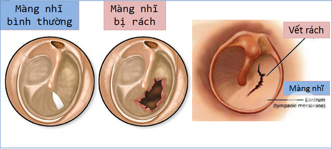 Bé gái bị thủng màng nhĩ do sự chủ quan của người mẹ - Ảnh 3.