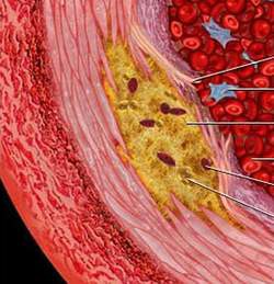Xơ vữa động mạch là gì? - Ảnh 1.