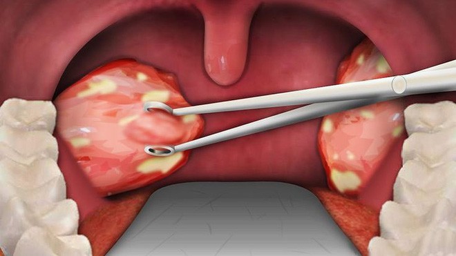 Hơi thở có mùi là dấu hiệu cảnh báo vấn đề sức khỏe gì? - Ảnh 4.