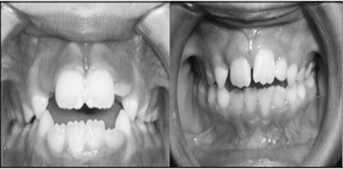 Cần nắn chỉnh răng cho trẻ ở tuổi nào? - Ảnh 2.