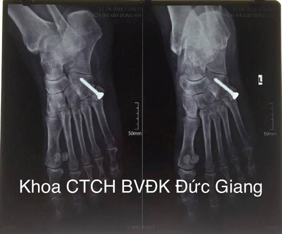 Cụ bà tự ý dùng thuốc corticoid suốt 20 năm khiến mặt tích nước, loãng xương - Ảnh 1.