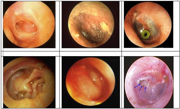 Thổi bột sắn dây, nhỏ nước gừng trị viêm tai giữa: Bài học quá đắt cho nhiều cha mẹ - Ảnh 1.