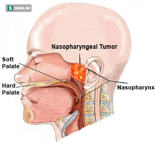 Nhớ các dấu hiệu ung thư vòm họng giai đoạn đầu, cơ hội sống sót lên tới 72% - Ảnh 1.