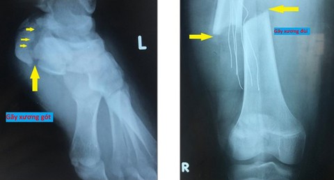 Rơi từ lầu 3, bé gái ở Sài Gòn thoát chết - Ảnh 1.