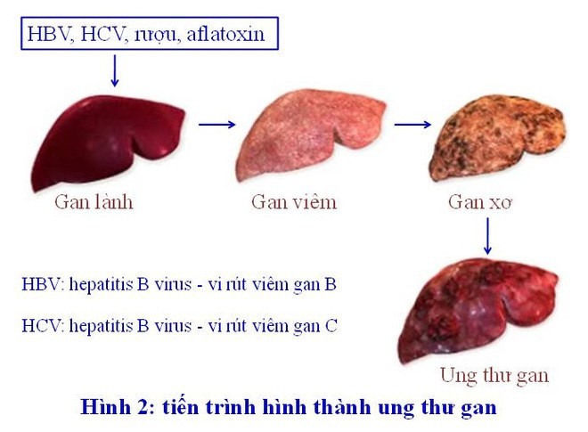 3 nhóm người có nguy cơ mắc ung thư gan cao nhất: Đừng để phát hiện khi ở giai đoạn muộn - Ảnh 2.