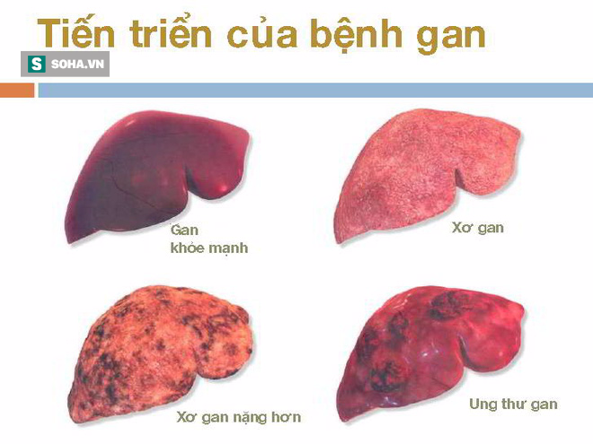 Xơ gan có thể dẫn đến ung thư gan: Đây là 4 nguyên tắc quan trọng giúp phòng ngừa hiệu quả - Ảnh 2.