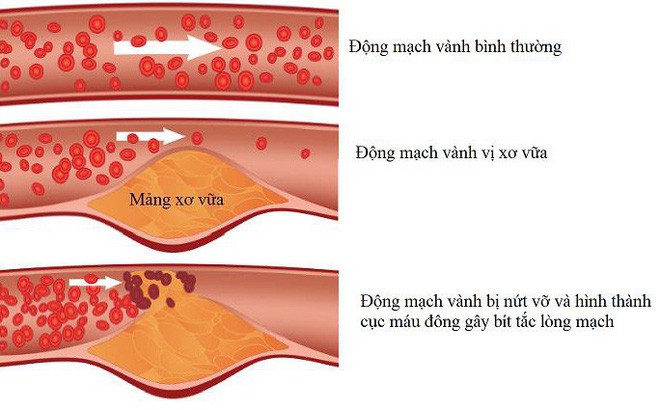 Phòng suy tim do bệnh mạch vành: Việc cần làm ngay trước khi quá muộn - Ảnh 1.