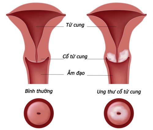 Là phụ nữ, cần cẩn trọng với 3 bệnh ung thư nguy hiểm - Ảnh 2.