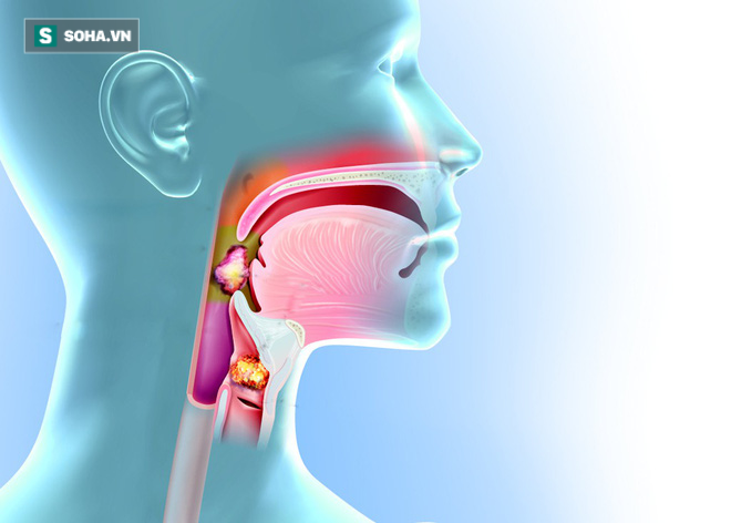 Đây là dấu hiệu sớm nhất của bệnh ung thư mũi họng: Cần nắm rõ để phòng bệnh kịp thời - Ảnh 1.