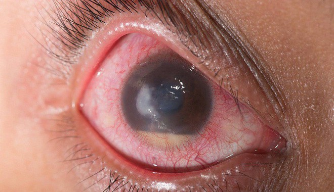 4 căn bệnh ở mắt nếu không chữa trị sớm có thể dẫn tới nguy cơ mù lòa - Ảnh 4.