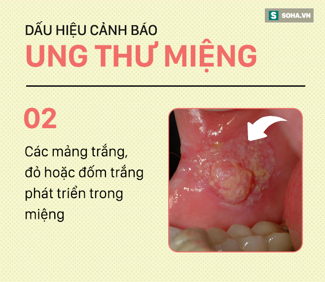 [PHOTO STORY] Đừng nhầm lẫn với bệnh ở miệng, đây là những dấu hiệu cảnh báo ung thư mà bạn nên nhớ - Ảnh 2.