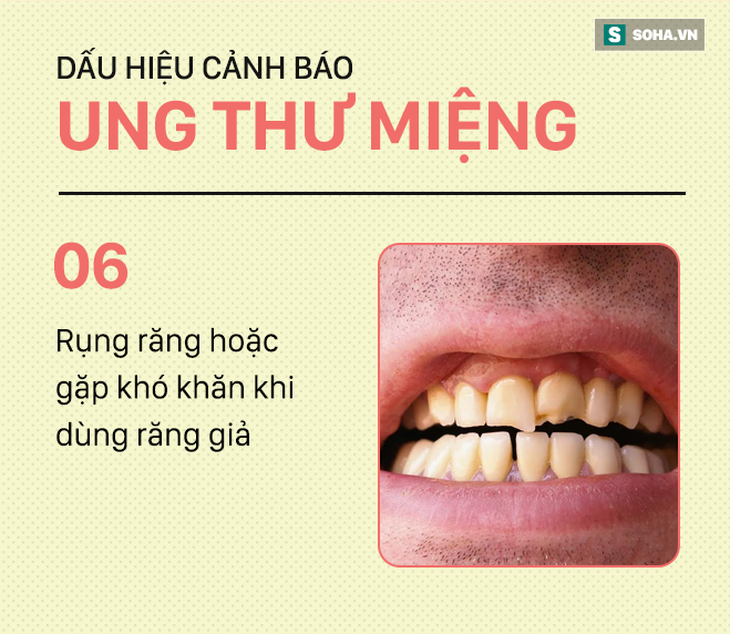 [PHOTO STORY] Đừng nhầm lẫn với bệnh ở miệng, đây là những dấu hiệu cảnh báo ung thư mà bạn nên nhớ - Ảnh 6.