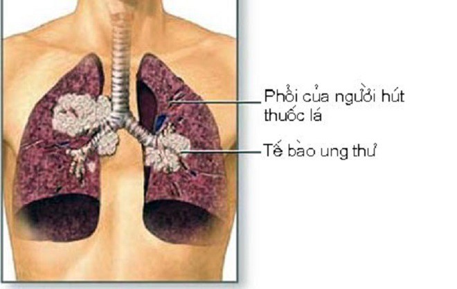 Ung thư phổi là bệnh có tiên lượng xấu: Chuyên gia chỉ rõ những dấu hiệu của bệnh - Ảnh 2.