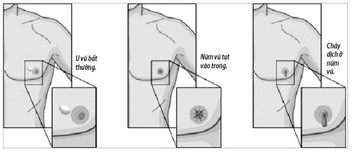 Các dấu hiệu báo động ung thư vú ở nam giới - Ảnh 1.