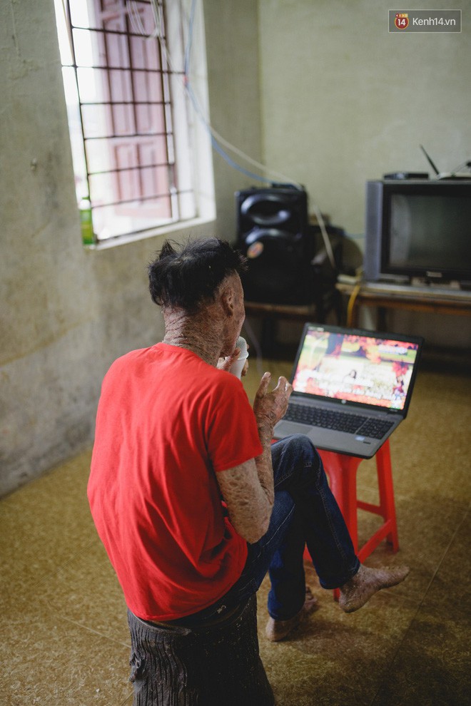 Chàng trai người cá lạc quan ở Hà Nội: Nhìn thấy bộ dạng của mình, nhiều người hỏi sao không chết đi, sống để làm gì? - Ảnh 5. Chàng trai người cá lạc quan ở Hà Nội: Nhìn thấy bộ dạng của mình, nhiều người hỏi sao không chết đi, sống để làm gì? - Ảnh 5.