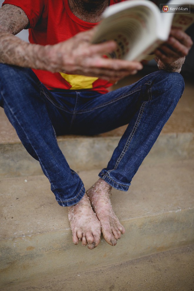 Chàng trai người cá lạc quan ở Hà Nội: Nhìn thấy bộ dạng của mình, nhiều người hỏi sao không chết đi, sống để làm gì? - Ảnh 7. Chàng trai người cá lạc quan ở Hà Nội: Nhìn thấy bộ dạng của mình, nhiều người hỏi sao không chết đi, sống để làm gì? - Ảnh 7.