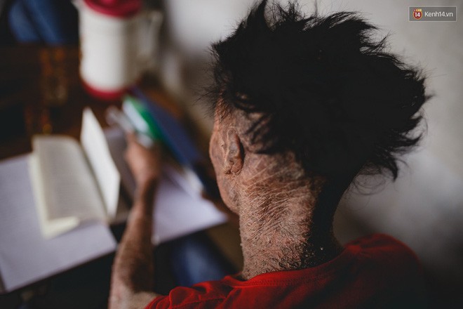 Chàng trai người cá lạc quan ở Hà Nội: Nhìn thấy bộ dạng của mình, nhiều người hỏi sao không chết đi, sống để làm gì? - Ảnh 9. Chàng trai người cá lạc quan ở Hà Nội: Nhìn thấy bộ dạng của mình, nhiều người hỏi sao không chết đi, sống để làm gì? - Ảnh 9.