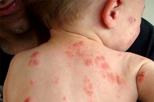 6 bệnh ngoài da hay gặp ở trẻ mùa nắng nóng - Ảnh 1.