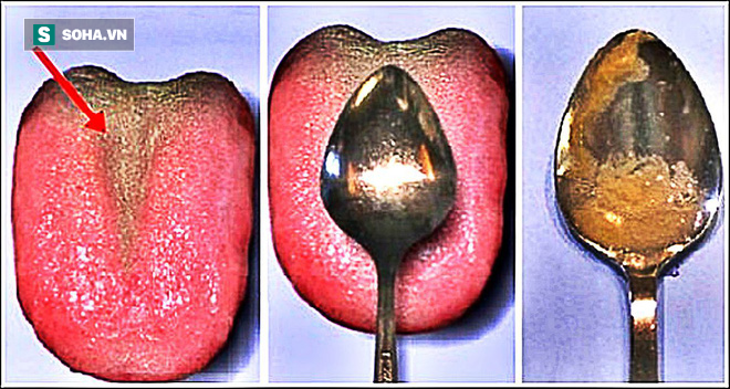 1 phút kiểm tra sức khỏe bằng 1 chiếc thìa phát hiện nguy cơ tiểu đường, bệnh phổi, dạ dày - Ảnh 1.