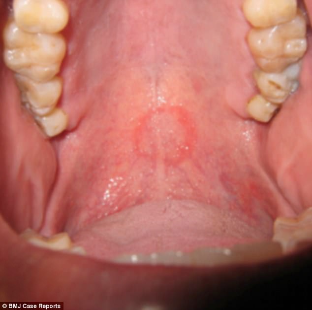 Do oral sex quá nhiều, vòm miệng của người đàn ông xuất hiện một dấu hiệu lạ - Ảnh 1.