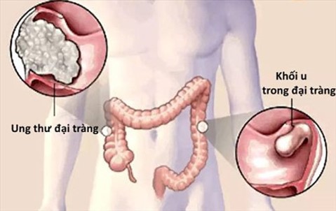 Bác sĩ Tiêu hoá cảnh báo 5 dấu hiệu sớm ung thư đại trực tràng: Hãy biết để tự cứu mình  - Ảnh 1.