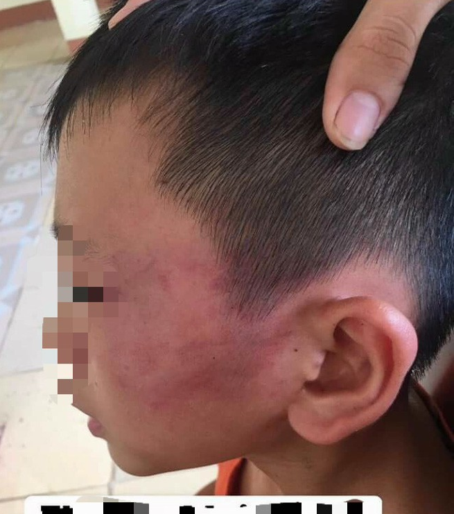 Nghệ An: Nghi án bé trai 12 tuổi bị mẹ kế đánh thương tích đầy mình phải nhập viện - Ảnh 1.