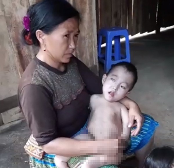 Điện Biên: Cảnh khốn cùng của gia đình dân tộc H’Mông có 3 chị em bị bệnh hiểm nghèo bị đồn do hôn nhân cận huyết - Ảnh 2.