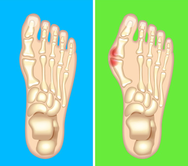 Nhìn ngay xuống bàn chân soi dấu hiệu bệnh tật cư trú trong người: Số 3 rất nguy hiểm! - Ảnh 7.