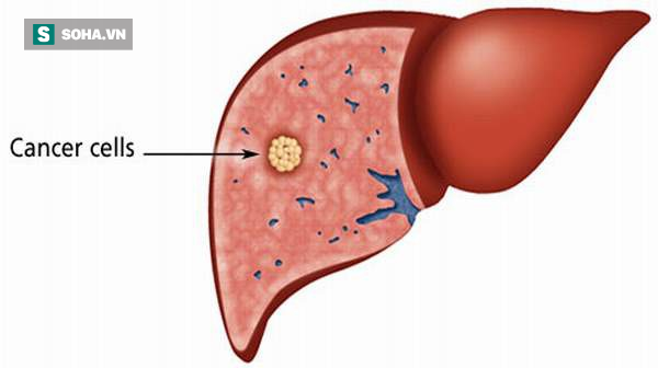 Bác sĩ Mỹ chỉ ra 8 đối tượng có nguy cơ cao bị ung thư gan: Nhiều người bị mà không biết - Ảnh 1.