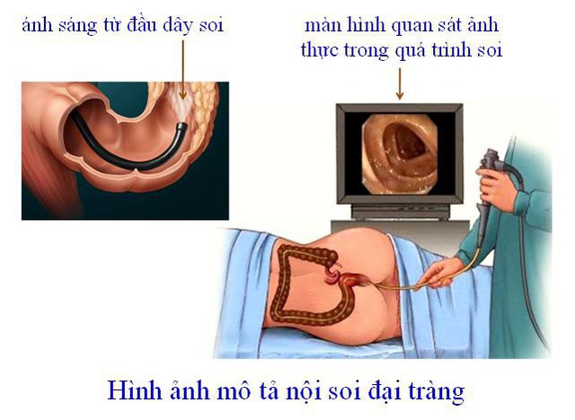 Viêm loét đại tràng có thể tăng nguy cơ ung thư đại trực tràng? - Ảnh 2.