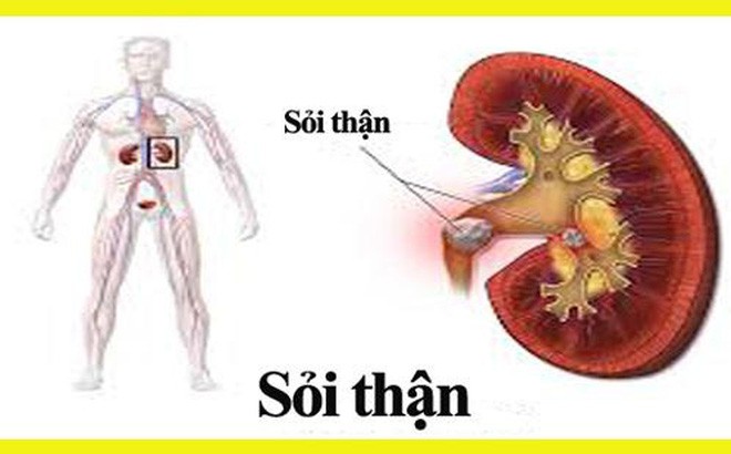 Bé 2 tuổi, 5 tuổi đã bị sỏi thận: Chuyên gia chỉ mặt nguyên nhân rất phổ biến - Ảnh 1.