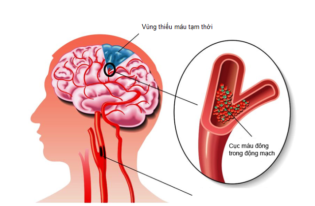 Hẹp van tim - “Thủ phạm” gây biến chứng chết người ít ai biết - Ảnh 1.