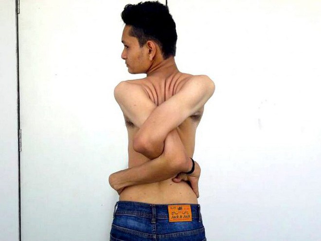 Gặp gỡ chàng trai Ấn Độ có cơ thể uốn dẻo như cao su, uốn vai 360 độ và xoay cổ 180 độ - Ảnh 5.